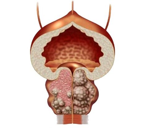 Adenoma in edema prostate in zdravljenja s kapsulami zxcvbnmqwert