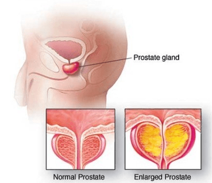 Normalna in vneta prostata