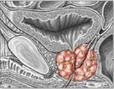 Kronični prostatitis